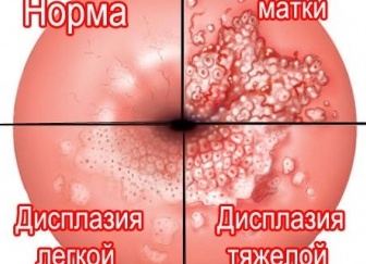 Дисплазия шейки матки. Что это такое и как защитить себя от этого грозного заболевания.