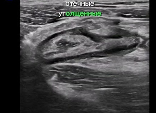 УЗИ