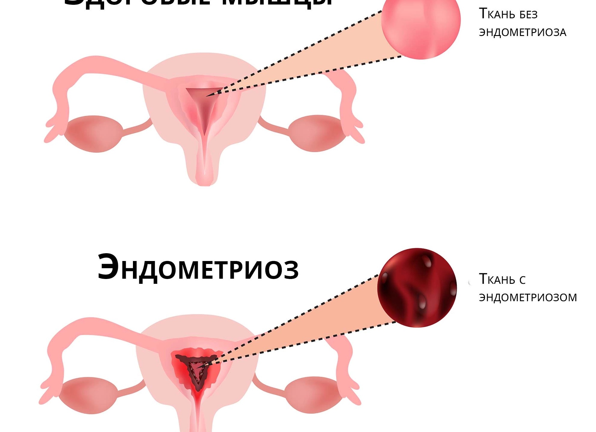 Эндометриоз. Что это, и как понять, что он есть?