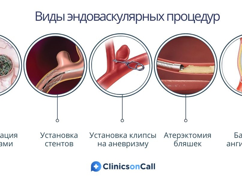 Эндоваскулярная хирургия