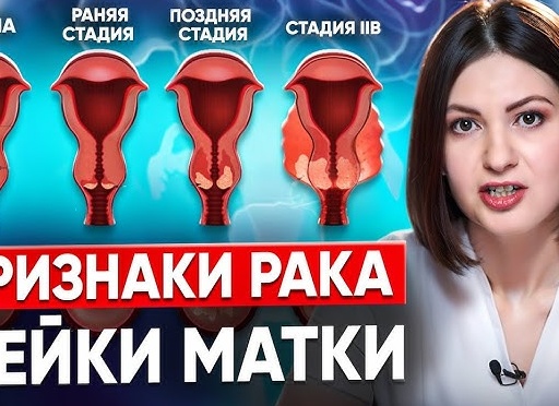 Стадии рака, в чем отличия?