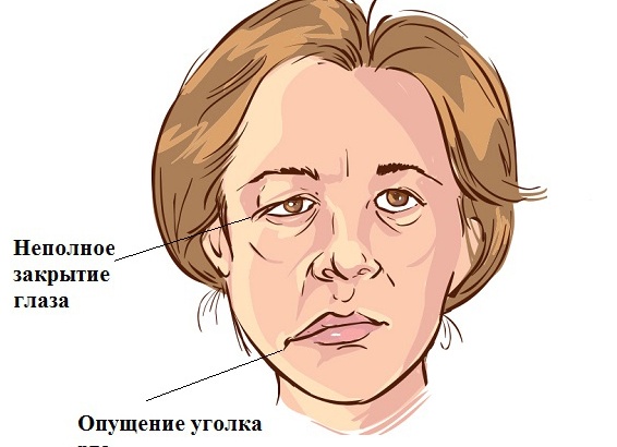 Неврит